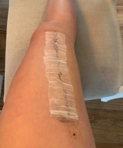 Alexis Carrico surgery 4.jpg