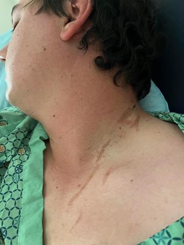 Tyler Morrison with burn mark on neck from lightning strike