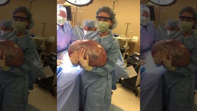 GRAPHIC: Alabama woman's 50-pound weight gain turns out to be massive ovarian cyst