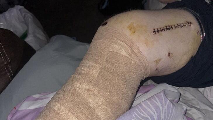 Brendan Hagan, Harvest Homecoming shooting victim's leg - 10.30.24