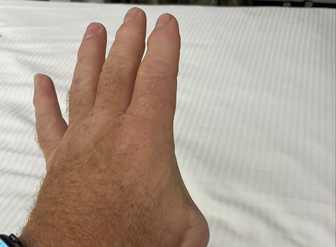 Rob Easter shows hand with no thumb
