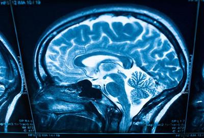 Stroke (generic) brain scan