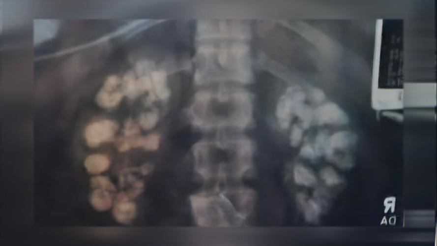 Debbie Lockard and Joyce Godfrey kidney donation