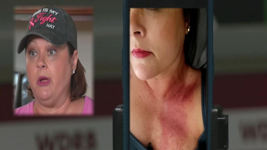 Tracy Bandy's chemo rash