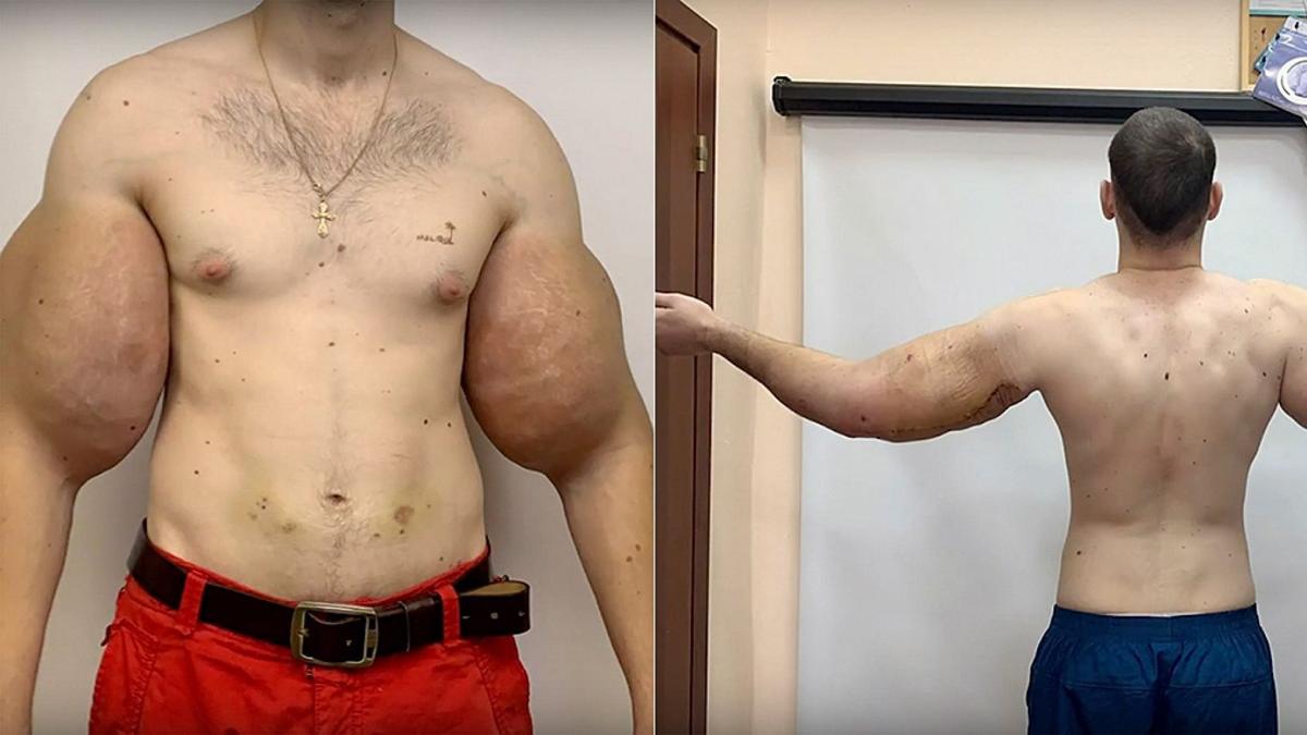 Russian 'Popeye' has 3 pounds of 'dead' muscle removed after DIY