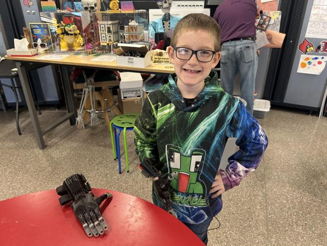 Glasgow boy with 3D hand