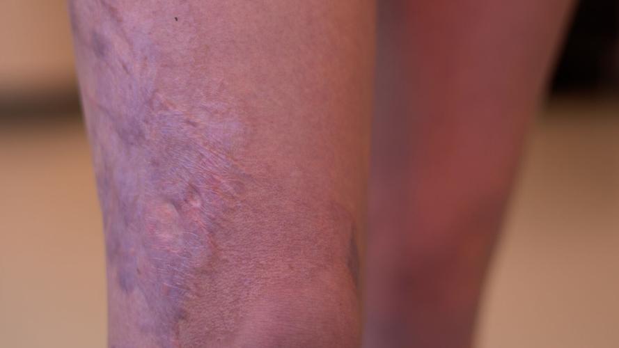 Scars from burns on the leg of Kennedy Moore, a CAL student