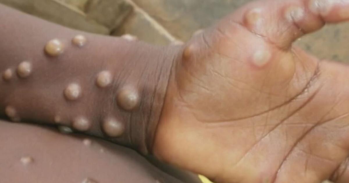Health experts in Louisville say the risk of monkeypox in children is low.news