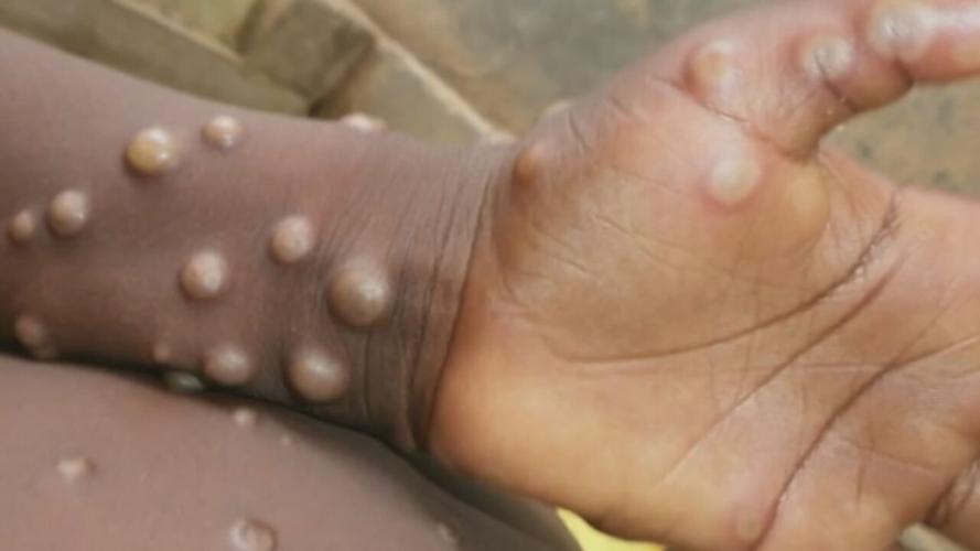 US Mpox cases double