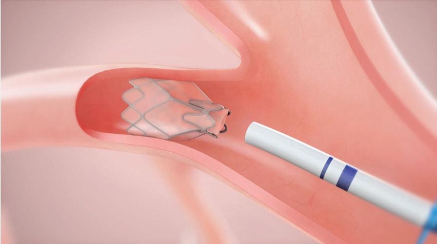 COPD TREATMENT PREVENTS TRANSPLANT FOR LOUISVILLE WOMAN 11-18-2021  (1).jpg
