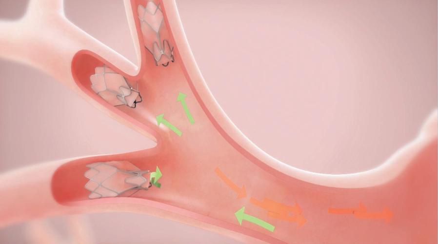 COPD TREATMENT PREVENTS TRANSPLANT FOR LOUISVILLE WOMAN 11-18-2021  (2).jpg