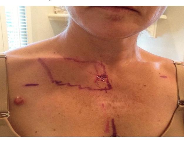 Tobi Sample melanoma