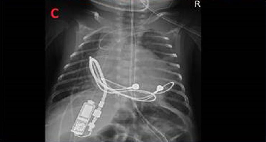 X-ray of 28-week-old infant with tiny pacemaker implanted by specialists at Norton Children's Heart Institute
