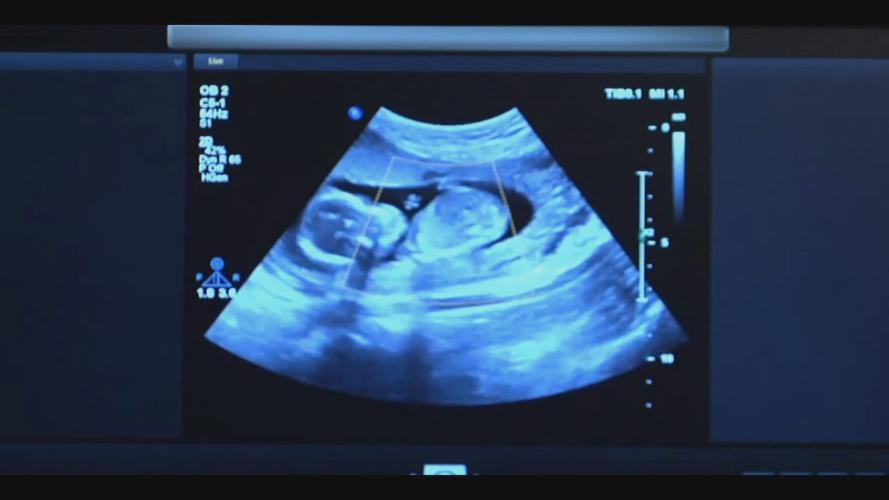 ABORTION - FETUS - SONOGRAM - BABY  (2).jpg