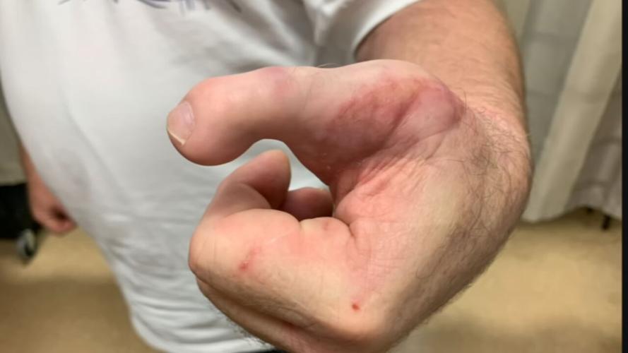 Rob Easter shows off his hand with new toe thumb
