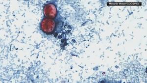 Outbreak of diarrhea-causing parasite linked to 4 more states