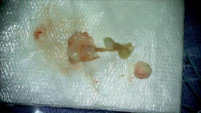 Tapeworm from Brain Surgery via Fox