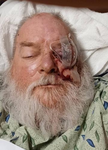 Jerald Hess fireworks injury