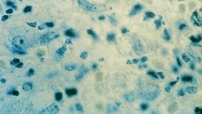 'Flesh-eating' STD allegedly reported in England