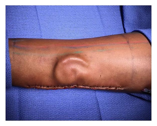 Ear Growing on Arm at Fort Bliss - image from DVIDS 2