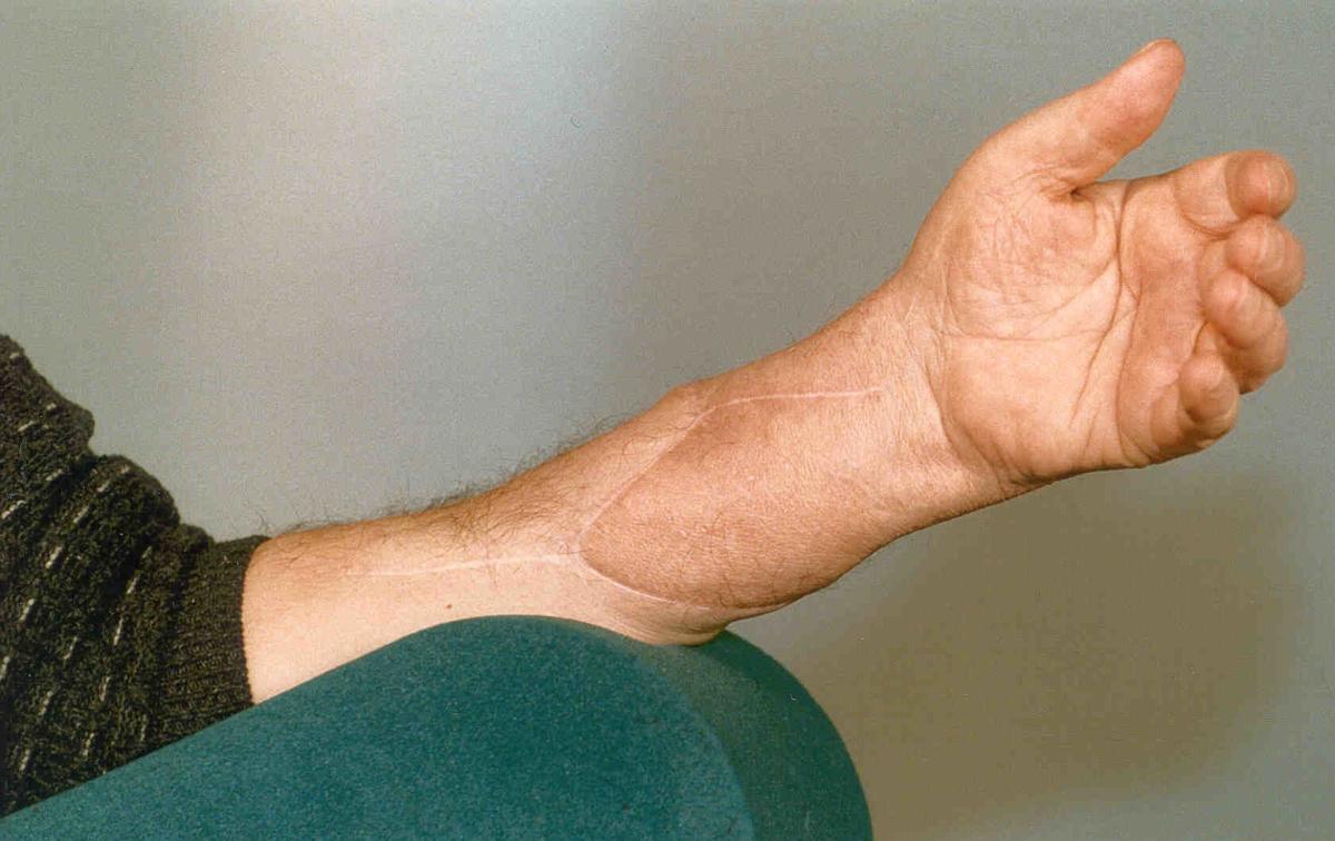 Images Nation S Most Successful Hand Transplant Recipient Marks 20 Years Since Surgery News Wdrb Com