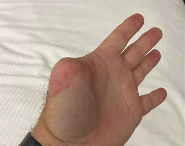 Joe Easter's hand with missing thumb