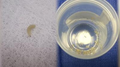 Louisville doctor using maggots to treat patients