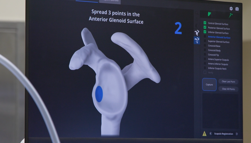 Robotic-assisted shoulder replacement at Norton Hospital