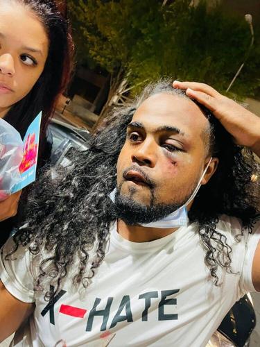 Denorver “Dee” Garrett displays an injury after being punched by a police officer near Jefferson Square Park