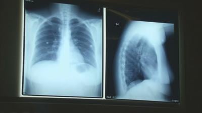 STATE OF LUNG CANCER KY 1130 VO