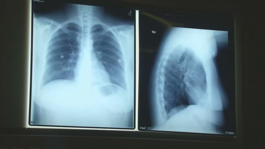 STATE OF LUNG CANCER KY 1130 VO