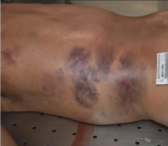 Clarke Bruises