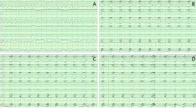 EEG OF DYING HUMAN BRAIN 1 - COURTESY.jpg