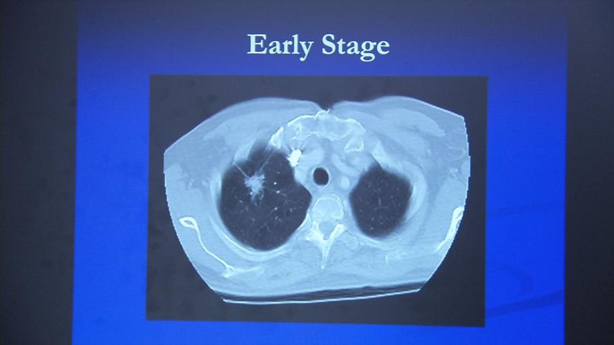 STATE OF LUNG CANCER KY 1130 VO