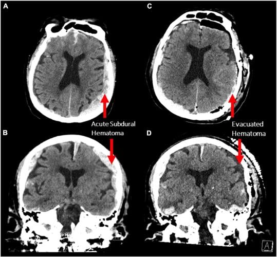 IMAGING FROM PATIENT WHO DIED DURING RECORDING OF BRAIN WAVES