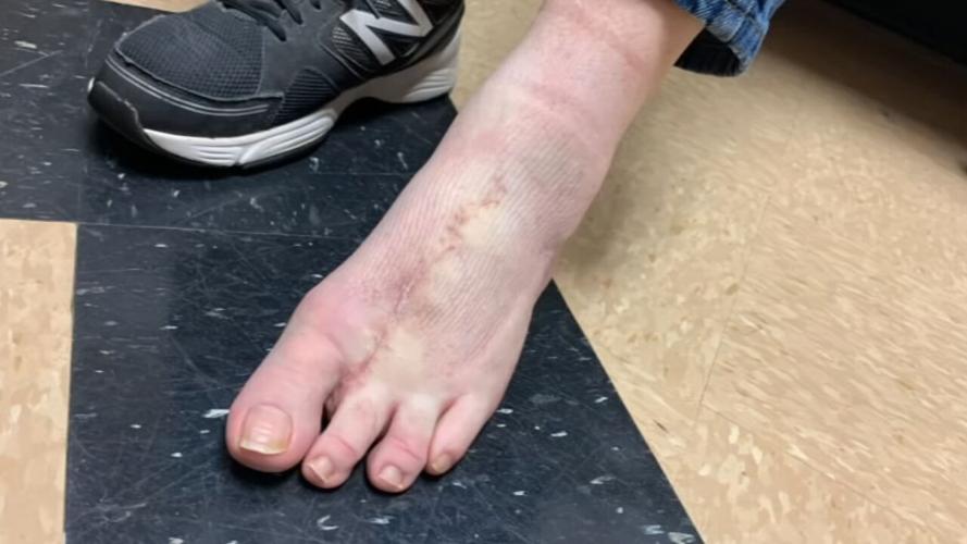 Rob Easter shows foot after surgeons use toe to replace his thumb