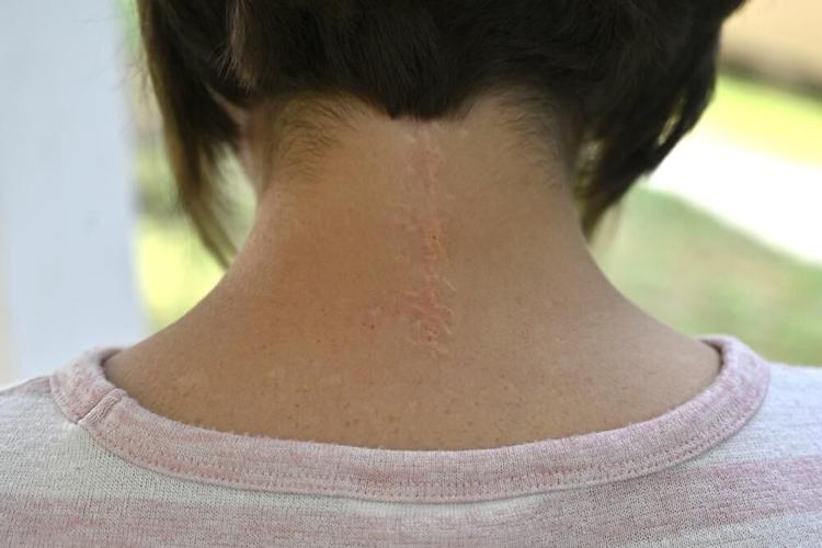 Mary Sexon shows her scars from brain surgery.jpeg