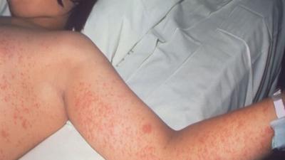 Generic measles