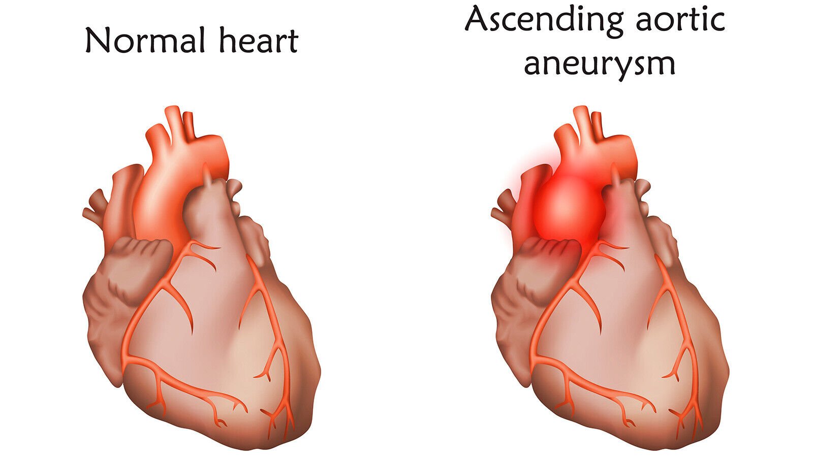 What is an aortic aneurysm Health wevv