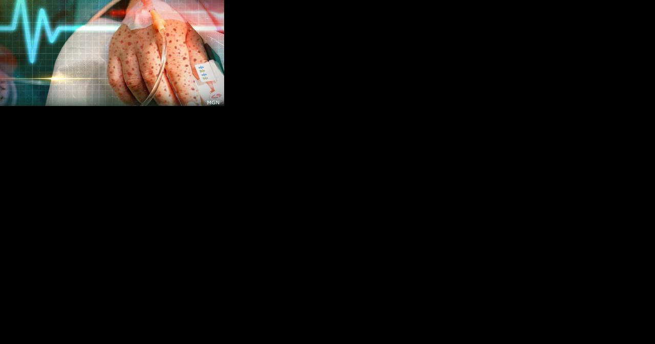 Kentucky reports 4 new measles cases, urges vaccinations