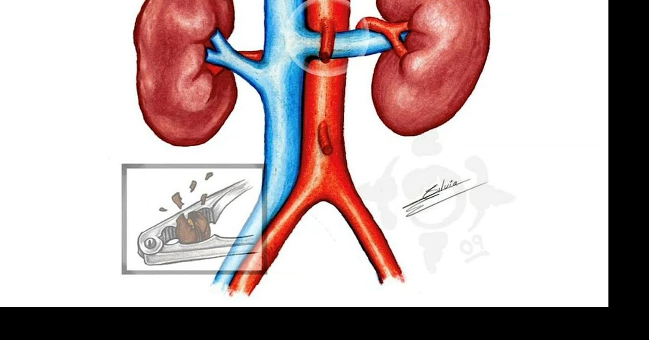 Health Beat Nutcracker syndrome surgery takes squeeze away Health