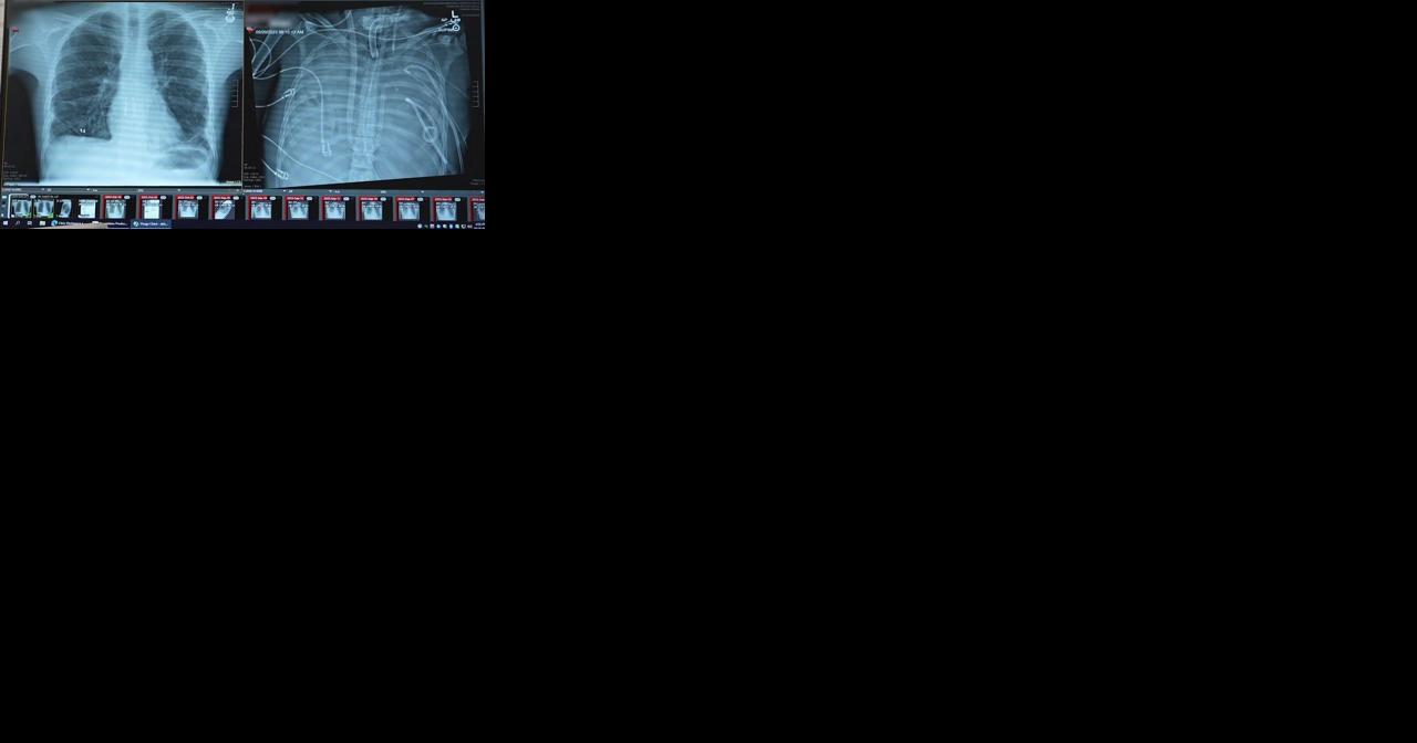 Health Beat: Living without lungs - Vimarsana News