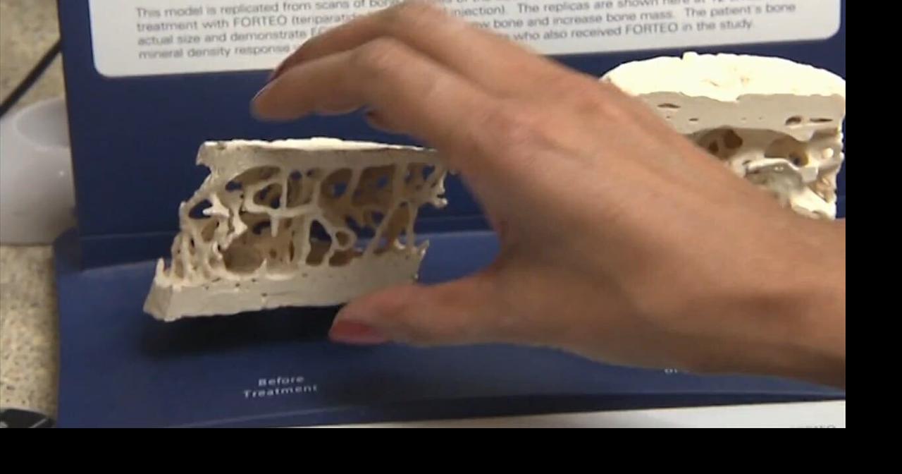 Health Beat: Vitamin D deficiency