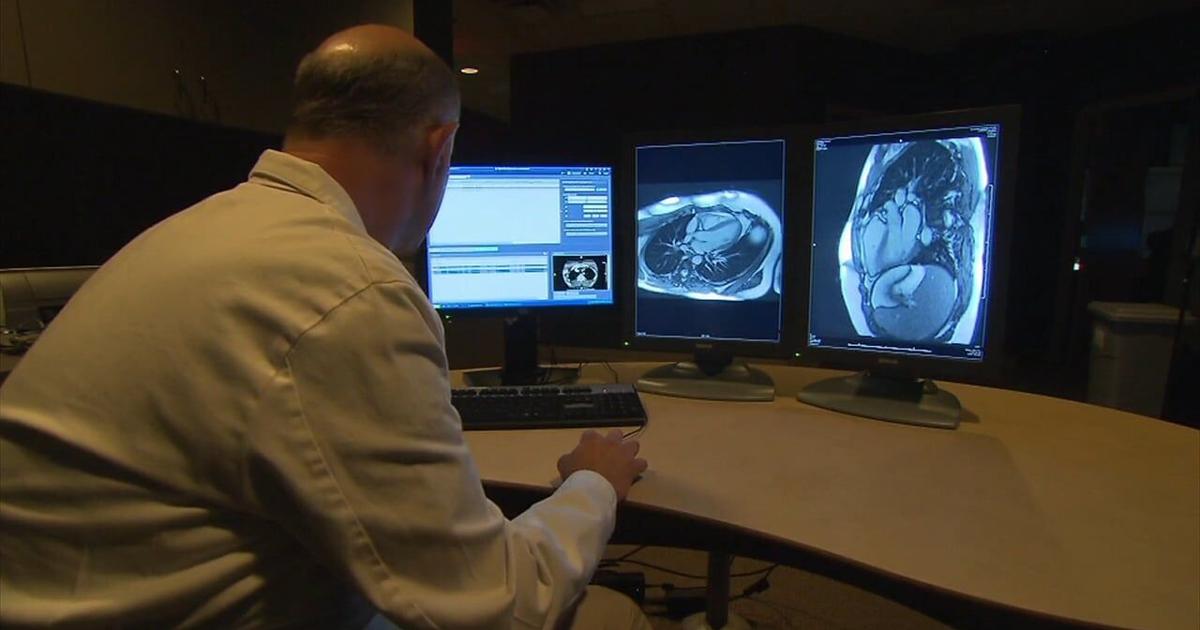 Health Beat: Heart attacks and cognitive impairment