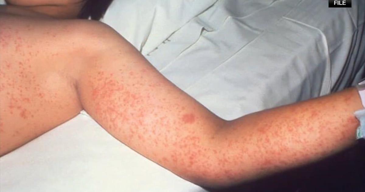 Montgomery County reports measles case linked to international travel - 69News WFMZ-TV