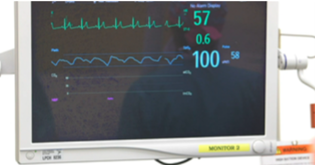 Health Beat: Intestinal transplant