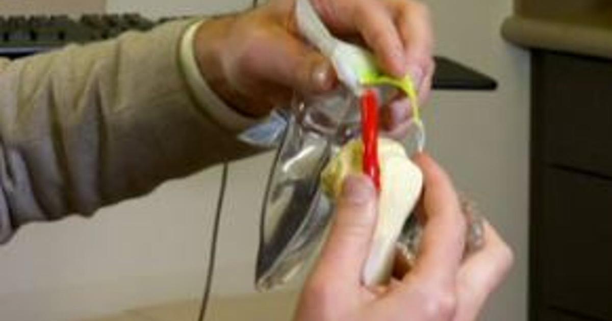 Baloon Spacwer Health Beat: Balloon spacers for rotator cuffs | Health Beat | wfmz.com