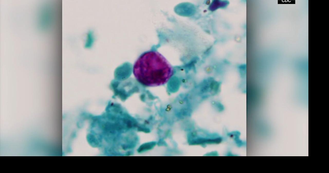 Cyclospora outbreak: 46 cases in New Jersey, 28 in Pennsylvania, including 5 cases in Bucks Co.