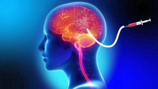 Health Beat Brain Tumor Catheter Glioblastoma Gps Health Wfmz Com Health Beat Brain Tumor Catheter Glioblastoma Gps Health Wfmz Com