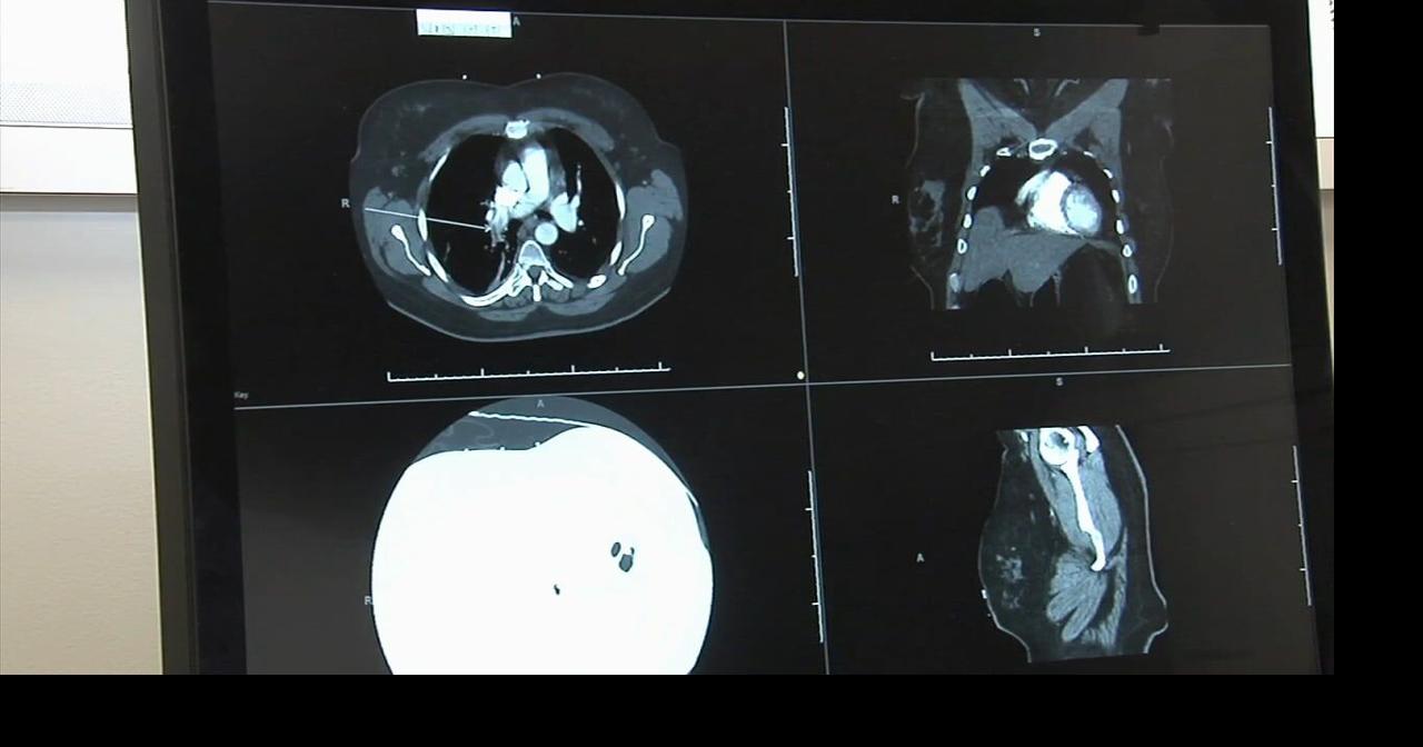 AI in the Lehigh Valley LVHN’s newest radiology tech can catch life